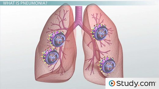 Viral and Fungal Causes of Pneumonia