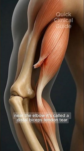 Distal Biceps Tendon Tear Surgery (3D Animation) #anatomy #biceps #muscletear