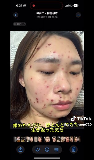 水疱瘡の症状と治療法