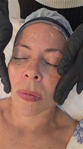 Primeiro procedimento concluído, bora pro próximo✨️ #mae #procedimentosesteticos #peeling