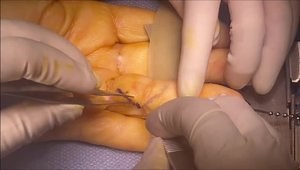 Dupuytren's Contracture Release