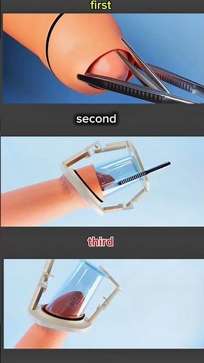 B Clamp Circumcision Disclaimer:This video is for educational purposes only#circumcision