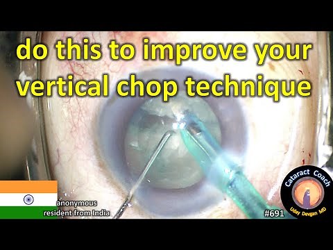 resident cataract surgery: improve your vertical chop technique