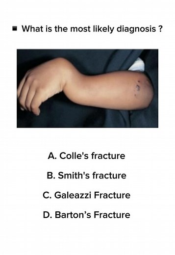 Understanding Colles’ Fracture: Symptoms and Causes
