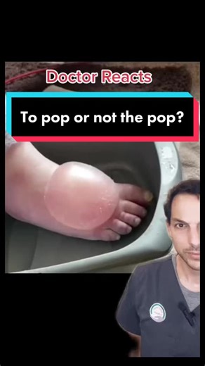 We generally recommend allowing a healthcare provider to evaluate you before doing anything with these larger than normal blisters. If it needs to be popped, it is safest to have a physician do it under sterile conditions in the office. #blister #burn #pop #drain #dr #medical