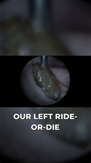 HUGE Earwax Plug Covered in Keratin! Earwax Removal | Wax Off Short Episode 88