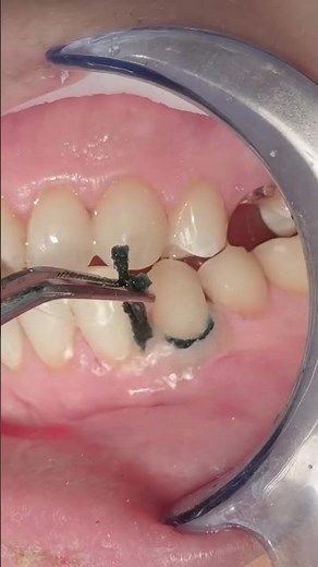 Class V composite restoration to canine & first premolar teeth #dentist