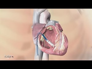 New pacemaker being used is 1/10th the size of a traditional one