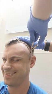 Having staples stitches removed from my head after brain surgery