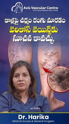 Can Varicose Veins Cause Skin Discoloration? | Dr. Soujanya | Avis Hospitals
