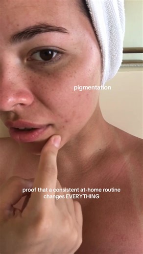 it took a while but it’s so worth it ❤️‍🔥 my glow up I got at home just using Korean skincare & massage & taping #skincare #glassskin #pigmentation #koreanskincare #kbeauty