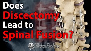 Does Discectomy Lead to Spinal Fusion? - ShimSpine