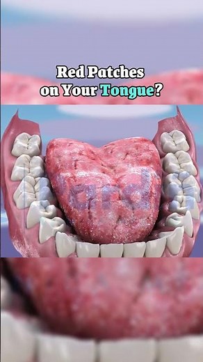 Red Patches on Your Tongue?