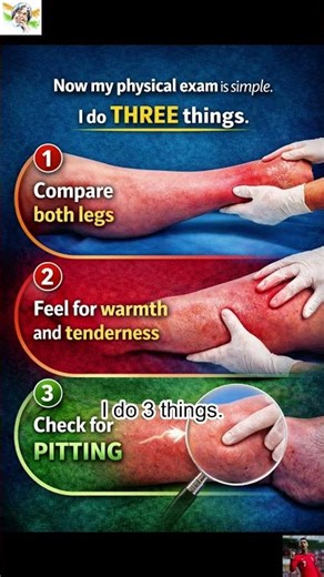 One Leg Swelling? Don’t Miss DVT | Quick Clinical Exam Guide 🚨