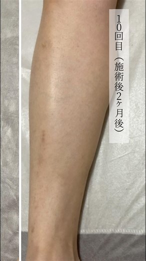 [Men in their 30s] Leg hair removal before and after!