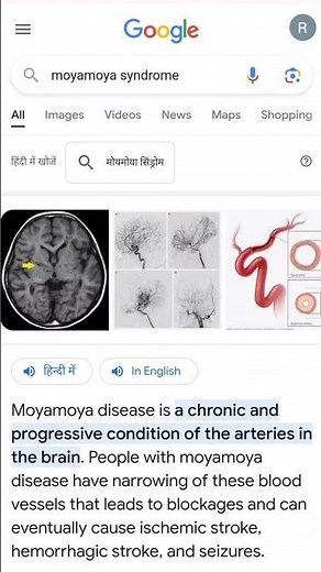 Moye Moye Syndrome
