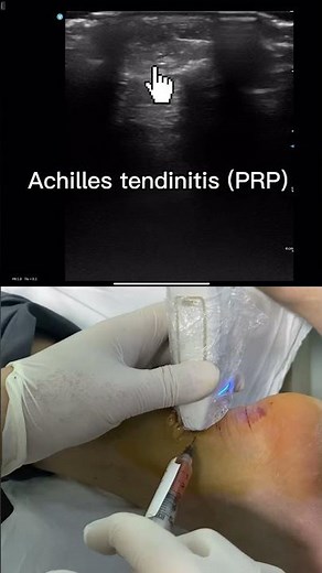 Achilles tendinitis (PRP injection)