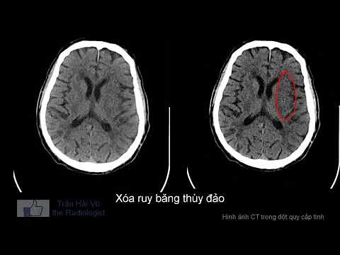 Hình ảnh CT trong nhồi máu não giai đoạn sớm.