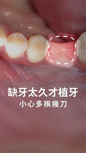 Waiting Too Long for an Implant? Prepare for Extra Surgery | Dr. David Yang, U-Min Dental Invisal...