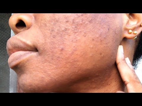 Fungal Acne Treatment | How I Beat Malassezia Fast & Effectively