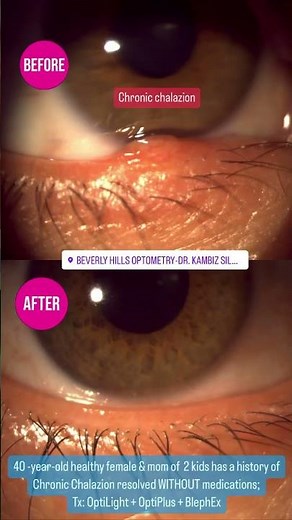 That chalazion definitely calmed down after OptiLight, OptiPlus and BlephEx 💪 #stye #chalazion