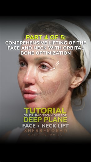 Ariel N. Rad, M.D., Ph.D., F.A.C.S. on Instagram: "Deep Plane Facelift Tutorial, Part 4️⃣ of 5️⃣: Combining Deep Plane Face & Neck Lift with Periorbital Optimization. Now that we’ve set the stage for a beautiful face and neck lift, harmonizing the upper half through periorbital optimization and microfat grafting completes the picture. This is where rejuvenation meets optimization for complete 10/10 results. The key 🔑 is to set the brow position with an endoscopic deep plane brow and forehead li