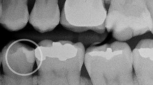 35K views · 207 reactions | 70% of clinicians find contact creation to be the most challenging part of a Class II restoration*. The Palodent® V3 Sectional Matrix System is designed to create predictable, accurate contacts, a tight gingival seal, and can be configured for multiple restorations at once. Request a demo now - https://goo.gl/tVMg1p *reference available upon request | Dentsply Sirona | Facebook