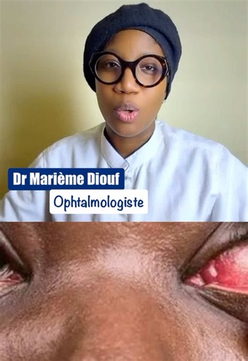 La conjonctivite des yeux dite « Apollo » est signalée en recrudescence dans plusieurs localités du pays . Les professionnels cités font état d’une circulation du virus et de nombreux cas recensés… Docteur Marième Diouf est revenue sur les causes de cette maladie, les manifestations et les moyens de prévention… #tiktoksenegal🇸🇳🇸🇳🇸🇳 #information #senegalaise_tik_tok🇸🇳 #pourtoi #viral
