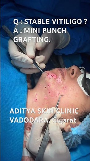 Stable Vitiligo on Face? MINI PUNCH GRAFTING ✨Natural repigmentation | Confidence restored 🙌Dr Sen