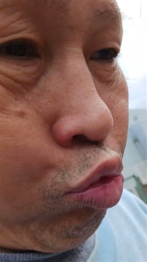 今話題のやせ薬マンジャロ 人工透析終わってから打つ事になって打っていますが 副作用ありますね 下痢と嘔吐ありますね
