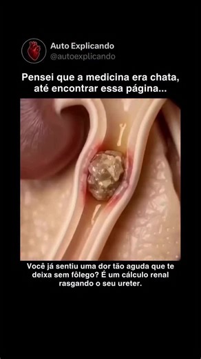 Cálculo Renal: Causas, Sintomas e Prevenção