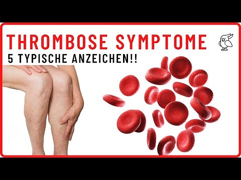 ❗THROMBOSE SCHNELL ERKENNEN❗ Diese 5 Thrombose Anzeichen/Symptome solltest du unbedingt kennen!!!