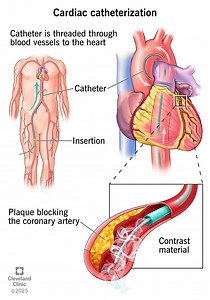 What Is Cardiac Catheterization?