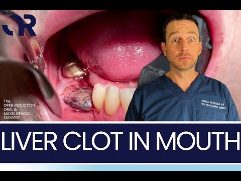 HUGE LIVER CLOT after TOOTH EXTRACTION!