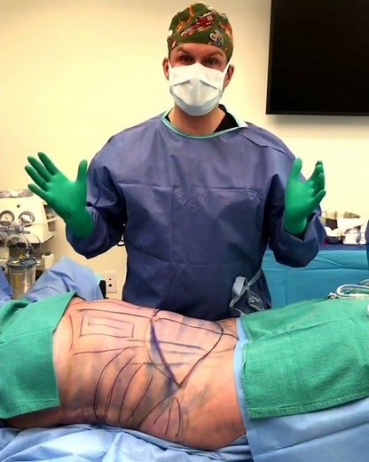 Visage Clinic's Dr. Marc DuPéré Live Surgery: Tummy Tuck (Abdominoplasty) with Liposuction