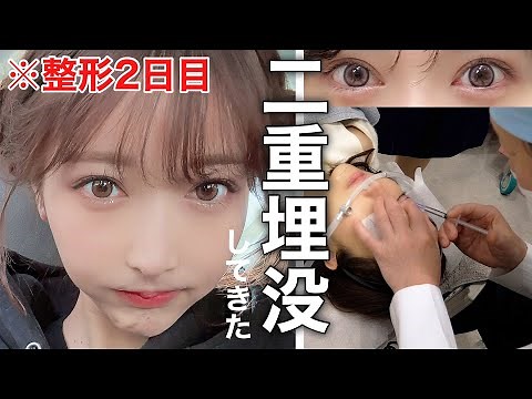 【二重整形vlog】やっぱり目の整形は怖かった。
