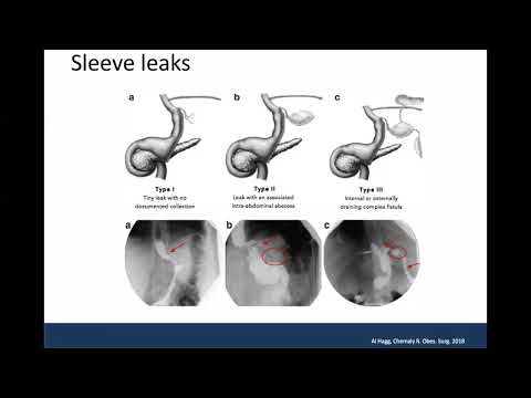 Complications After Sleeve Gastrectomy: Leaks, Bleeds and Thromboembolic Events