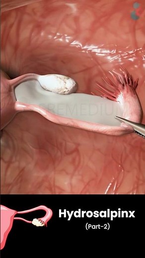 Hydrosalpinx | Part - 2 | 3D Medical Animations | #Hydrosalpinx #Infertility #IVF