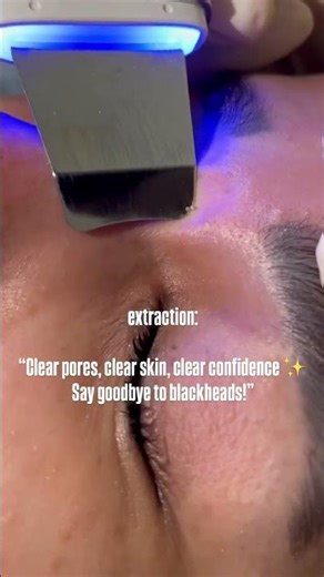 “Facial extraction isn’t just about clearer skin — it’s about healthier pores, fewer breakouts