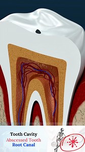 59K views · 931 reactions | ROOT CANAL TREATMENT- Abscess Tooth - Cavities - endodontics - RCT #rootcanal #cavities #humanbody Our previous root canal reel collected millions of likes across our channels, so we decided to share with you the full version in here. Check our article about root canal procedure: shorturl.at/fGJZ1 Medical Arts Official, 2023. | Medical Arts | Facebook