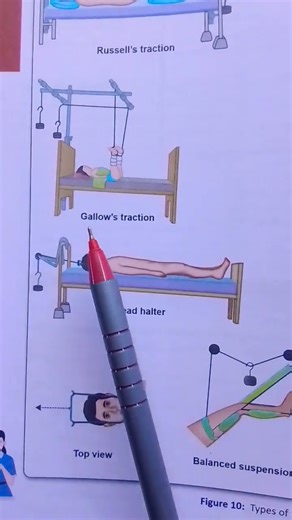 #types of #traction#nursing #students