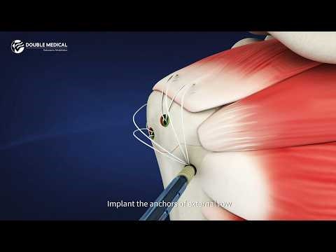 Merit MCT Ti Suture Anchor | One-Step Avulsion Fracture & Soft Tissue Fixation