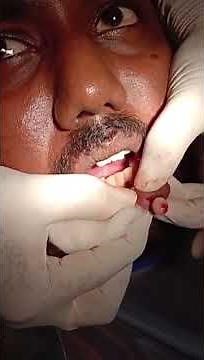 MUCOCELE EXCISION DONE BY DR MAHESH