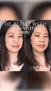 BOOKMARK THIS. In Chinese medicine, facial bloating is a case of excess dampness, weakness of organ channel Qi (energy), and/or excess tightness and tissue obstruction. Facial Gua Sha helps by improving the circulation of blood, releasing tightness and blockage in the fascia and muscle layers, and stimulating better function of the energy channels in our face neck and body (which in turn improves fluid circulation). Caution with these tips if you have rosacea - apply gentler, slower Gua Sha stro