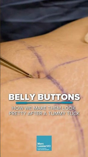 How We Make Belly Buttons Look Pretty After a Tummy Tuck #bellybutton #tummytucksurgery