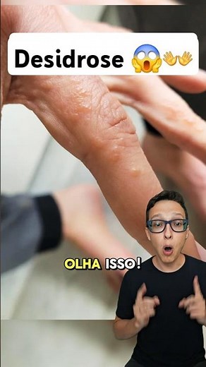 Disidrose 😱#medicina #medico #dermatologista #dermatologia eczema atópico dermatite desidrose na mão