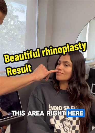 Awake Rhinoplasty for Comfortable and Quick Recovery