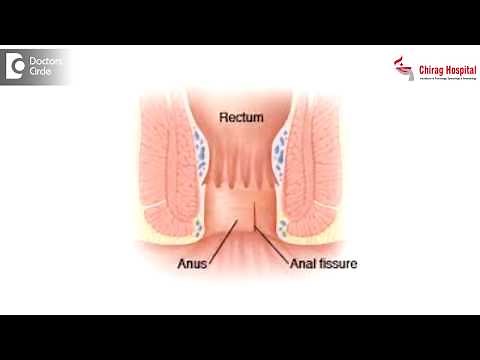 How is Botulinum toxin used to treat anal fissures? - Dr. Rajashekhar