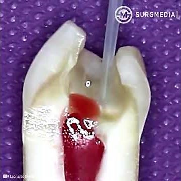 Pulpotomy Procedure: This is How Tooth is Cleaned and Prepared for Dental (Cavity / Tooth) Filling