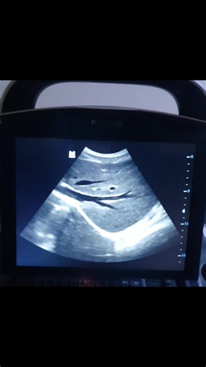 Liver scanning in portable mindray ultrasound power doppler with convex prob available in stock Delivery all over pakistan Contact:03354592219 Lahore pakistan. | Ultrasonography